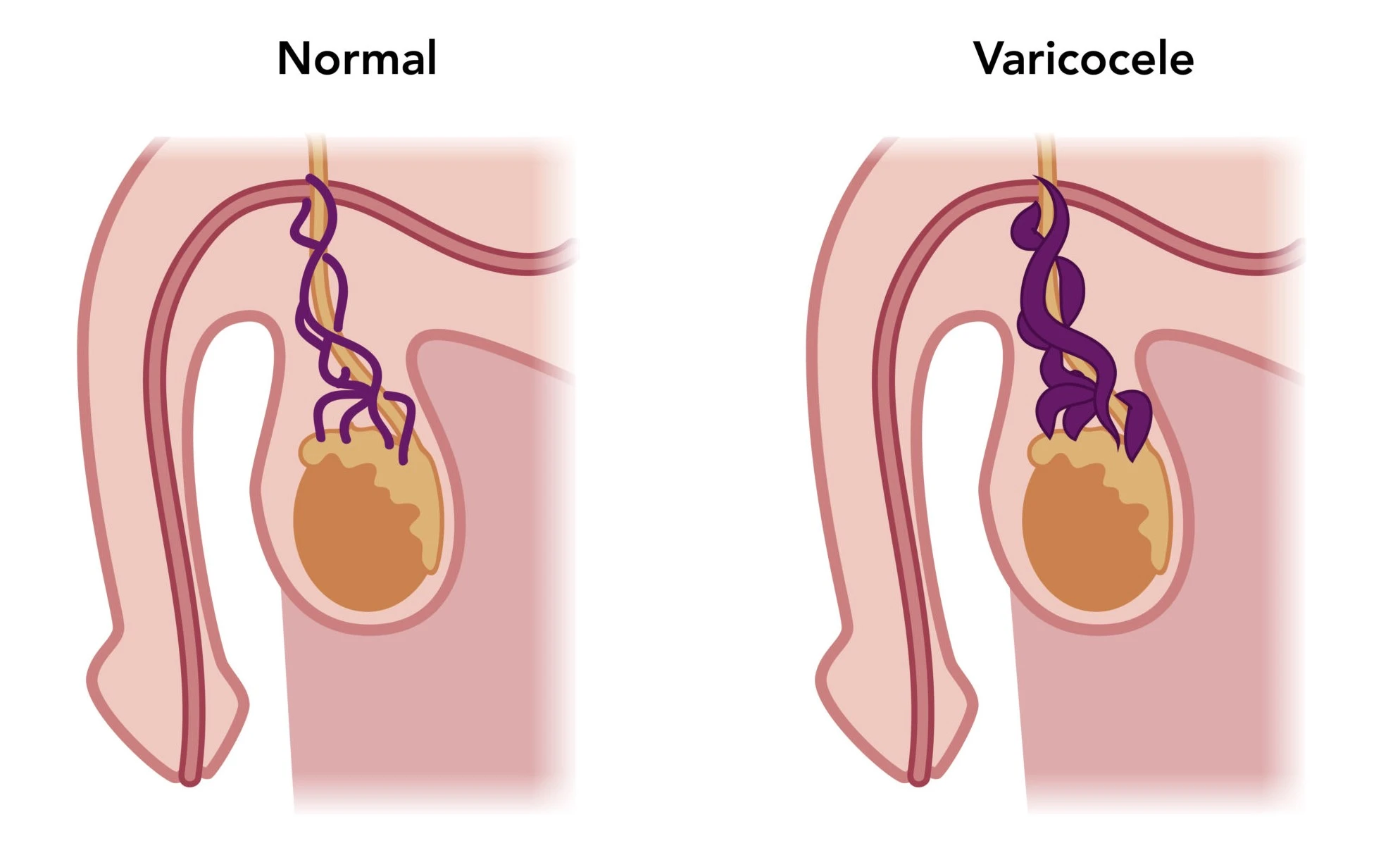 What is Varicocele and How Does It Affect Your Health